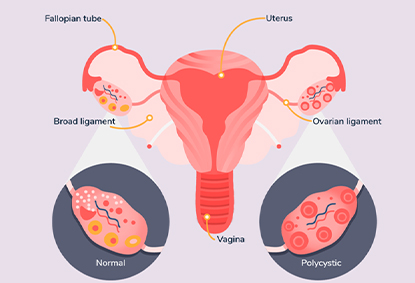 Top 10 Natural Treatments For Managing PCOD And PCOS